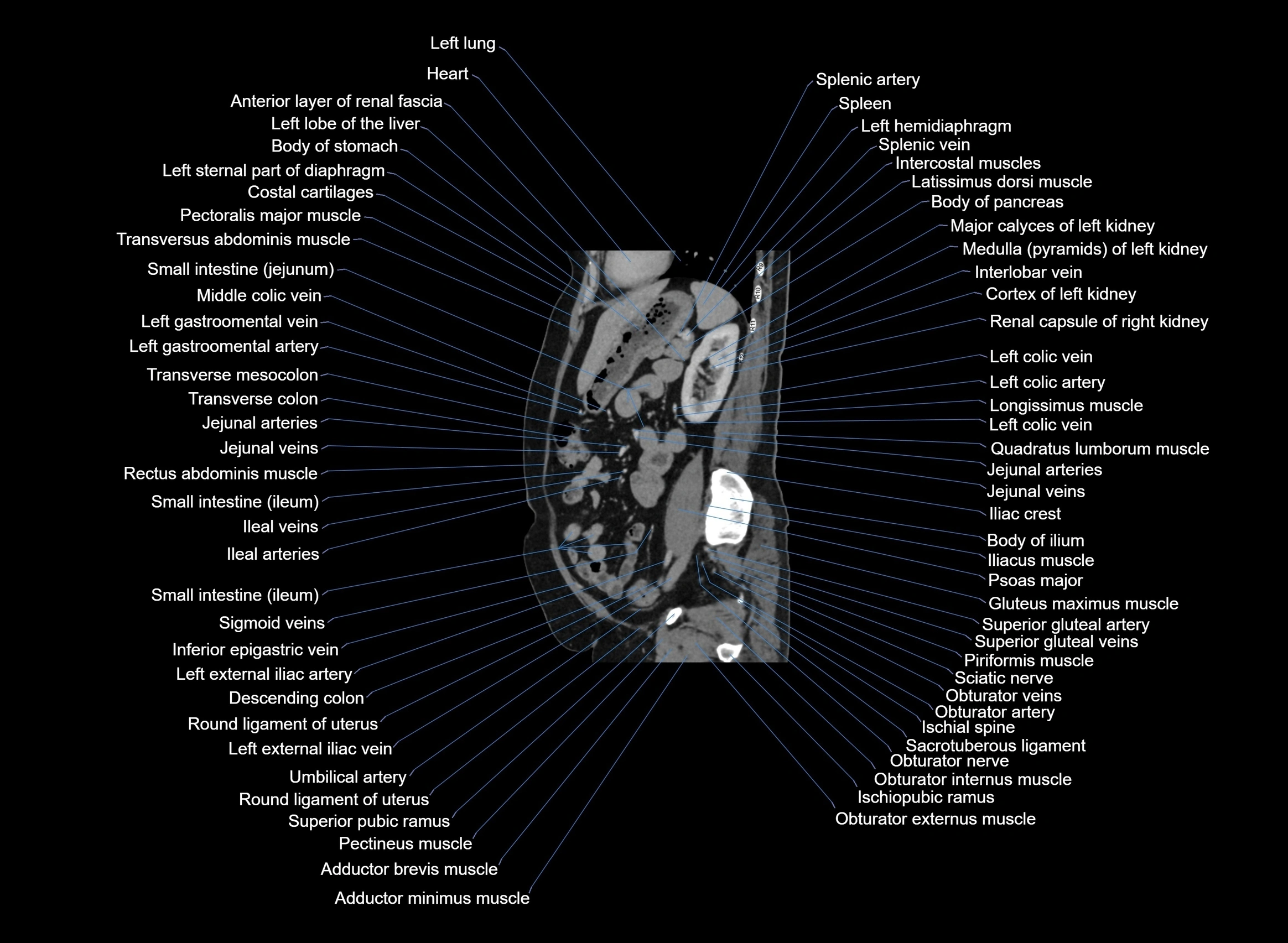 CT Abdomen sagittal cross sectional anatomy labelled radiology image -00040.webp